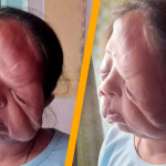 Woman with ‘melting face’ condition shares her experience living with it