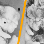 Shocking Scans Reveal Hair and Body Parts Developing on Rare Tumor Inside Woman’s Body